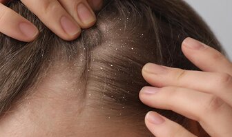 Ako sa zbaviť lupín vo vlasoch? Účinné rady a tipy