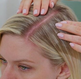 Suchá pokožka hlavy - hlavné príčiny a účinné riešenia